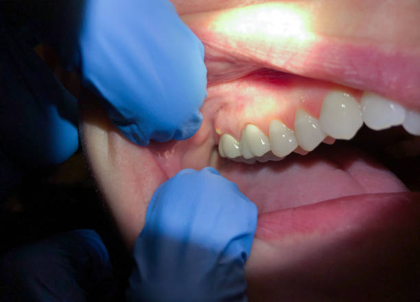 Best Emergency Denture Repair in Highland, MD